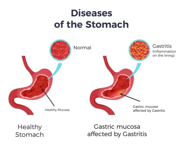 Does Coffee Cause Gastritis