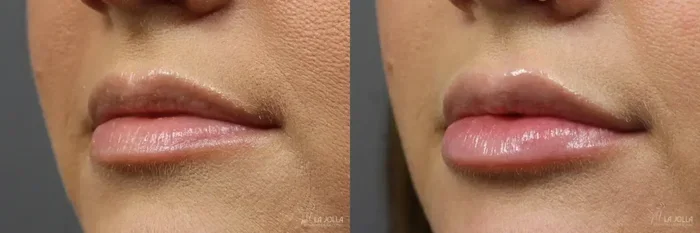 Can I Drink Coffee After Lip Filler