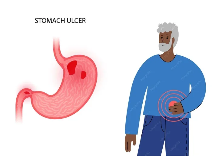 Can Coffee Cause Ulcers
