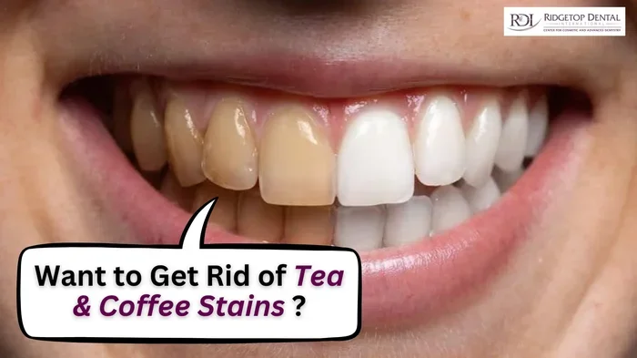 How to Keep Coffee from Staining Teeth