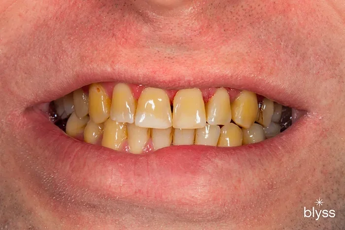 Can Coffee Stain Your Teeth