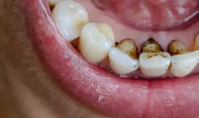 Can Coffee Stain Your Teeth