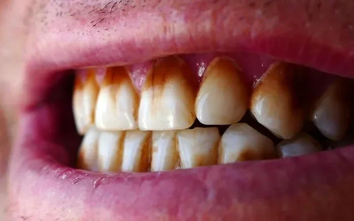 How Bad Is Coffee for Your Teeth
