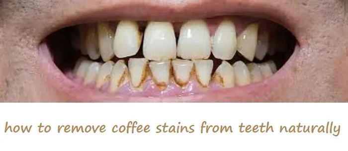 How Bad Is Coffee for Your Teeth