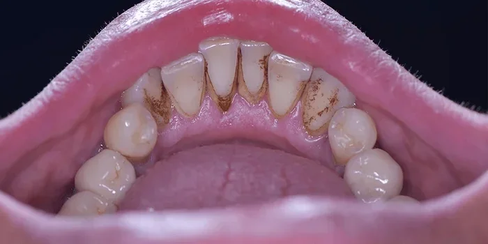 How to Remove Coffee Stains from Teeth