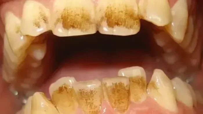 How to Remove Coffee Stains from Teeth