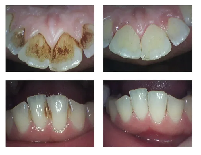 How to Remove Coffee Stains from Teeth