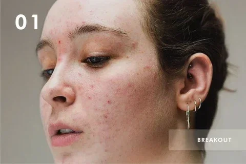 Does Coffee Cause Breakouts