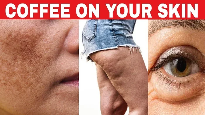 Does Coffee Cause Breakouts
