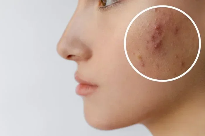 Does Coffee Cause Breakouts