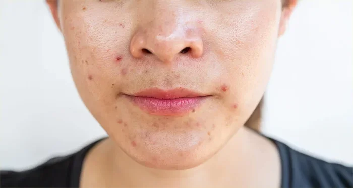 Does Coffee Cause Breakouts